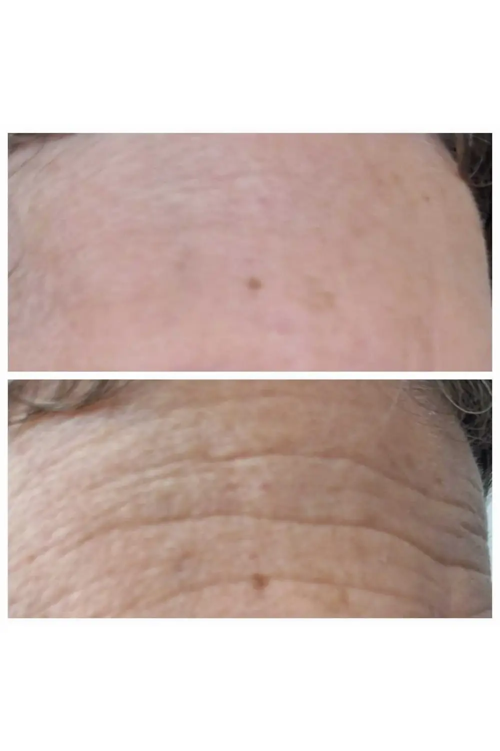 8 Milyon Mikro Iğne Içeren Kalıcı Botoks Etkili Anti-aging Kremi,