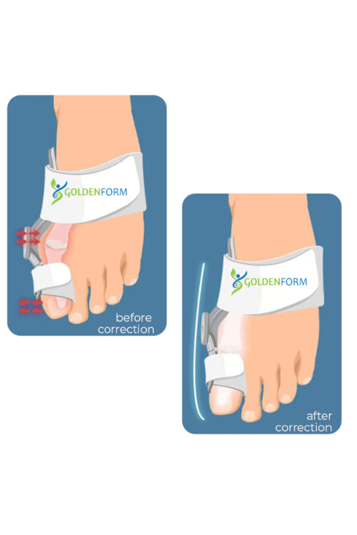 Açı Ayarlı Halluks Valgus Ateli - Ayak Baş Parmak Kemik Düzeltici