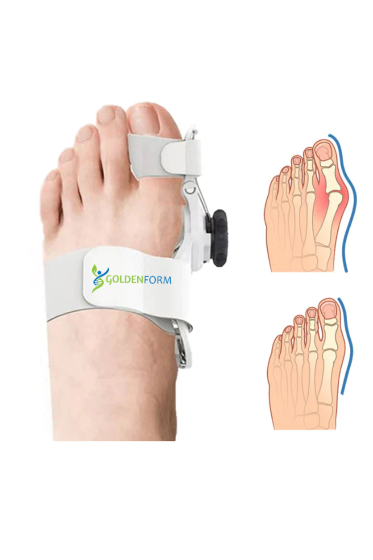 Açı Ayarlı Halluks Valgus Ateli - Ayak Baş Parmak Kemik Düzeltici