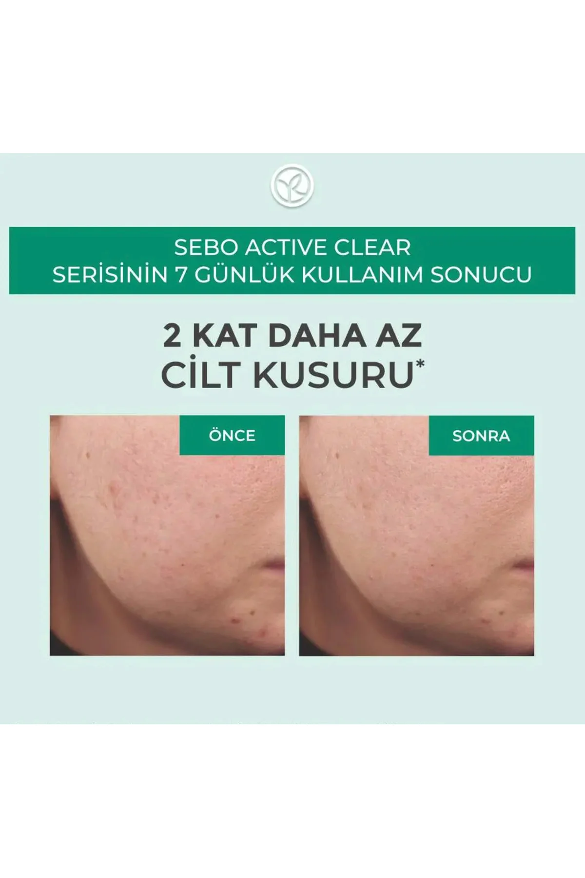 Akne/ Karşıtı Krem-Süksinik Asit&Allantoin&Aloe Vera-Sebo Active 