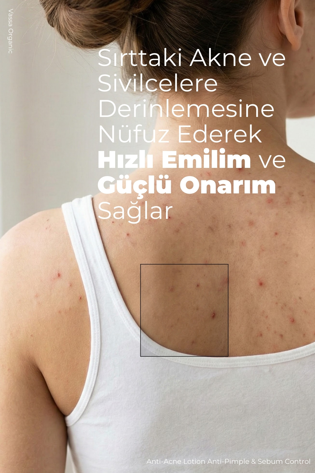 Akne, Sivilce ve Leke Karşıtı Onarıcı Bakım Kremi – Akne ve Sivilce Karşıtı Krem 100 ml