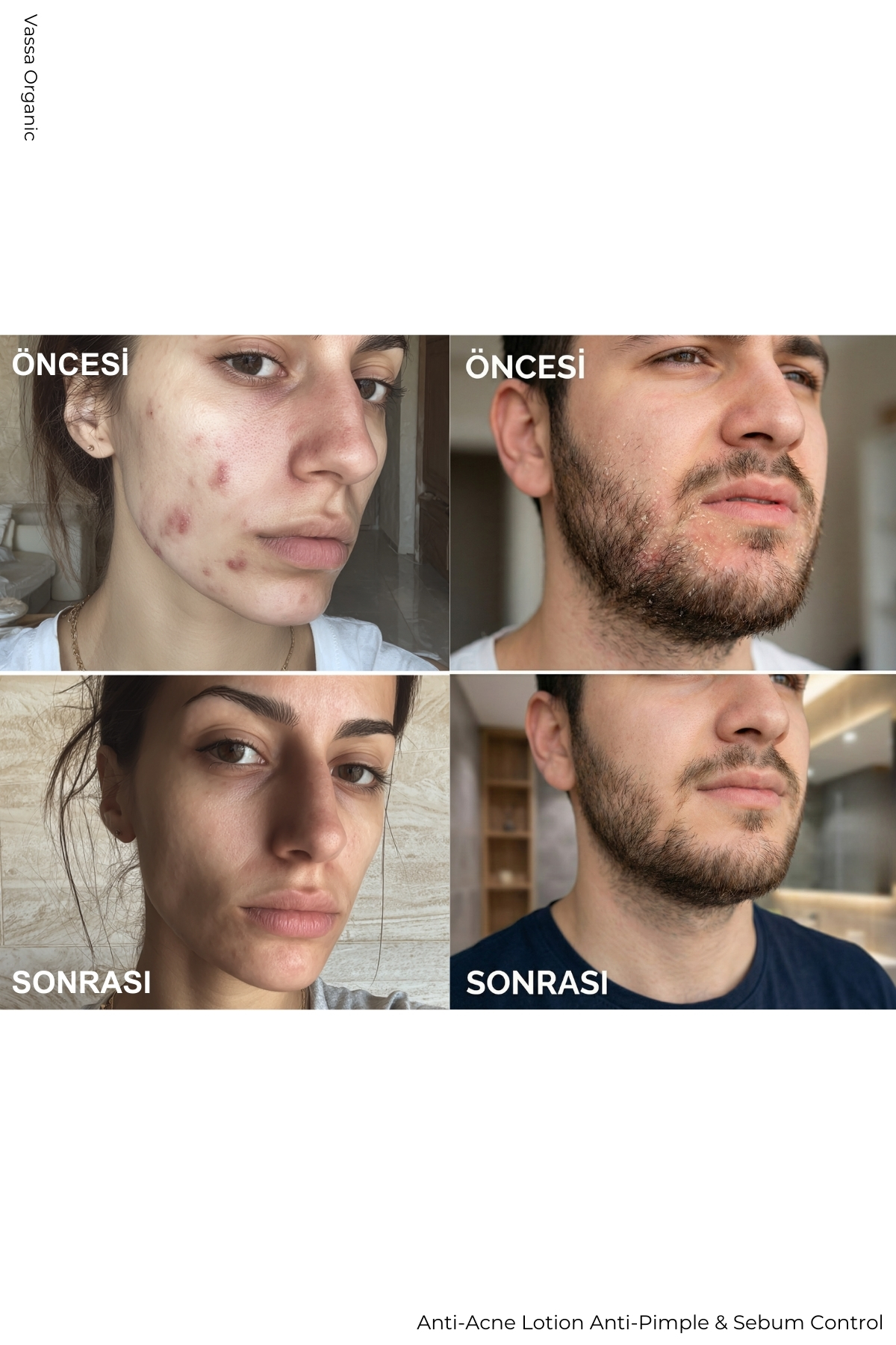 Akne, Sivilce ve Leke Karşıtı Onarıcı Bakım Kremi – Akne ve Sivilce Karşıtı Krem 100 ml