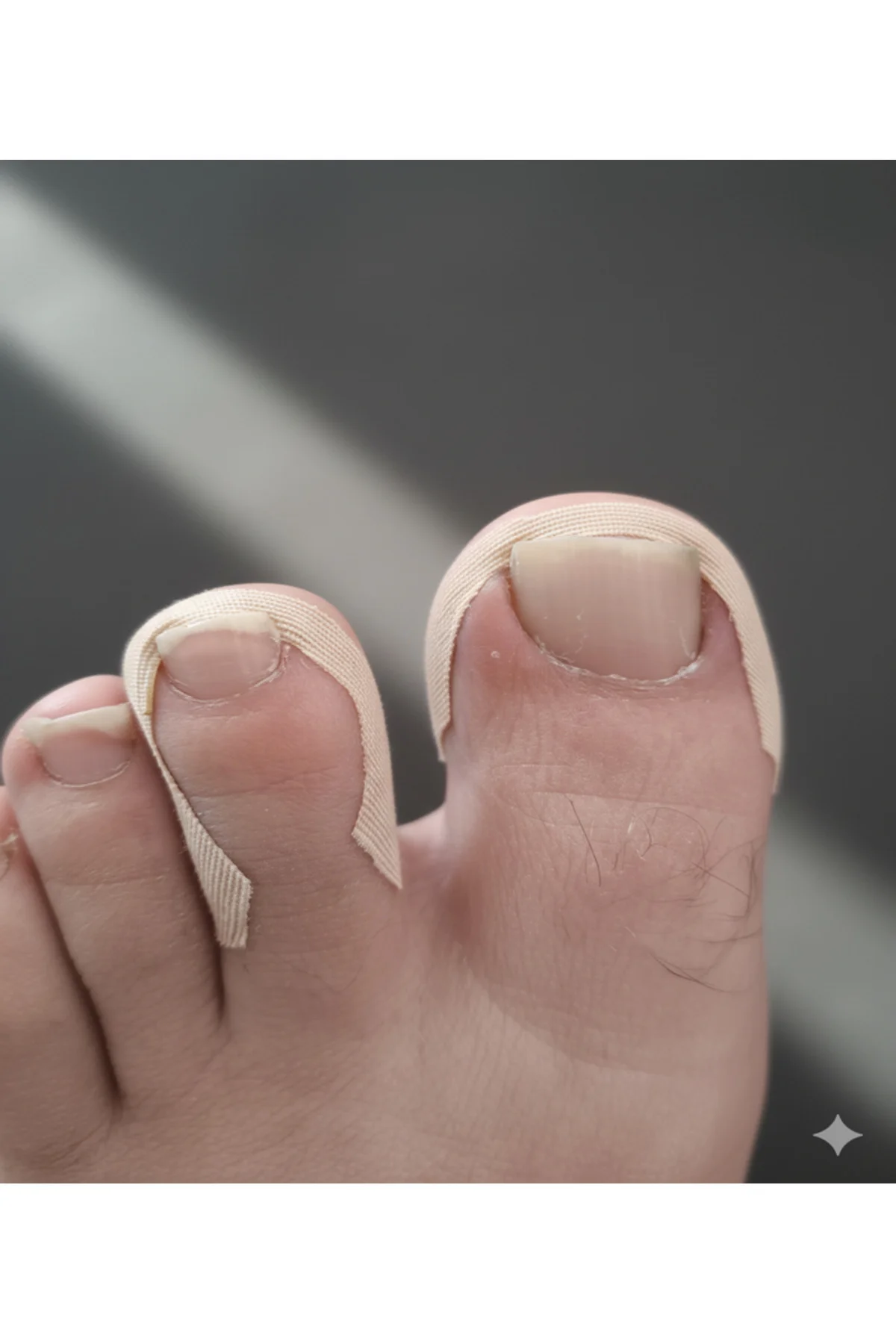 Ayak Tırnağı Düzeltme Bandı 10 adet