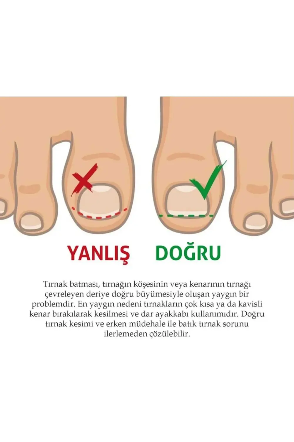 Ayak Tırnağı Düzeltme Bandı 10 adet