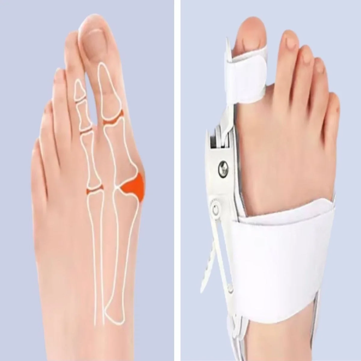 Ayarlanabilir Ayak Baş Parmak Kemik Düzeltici – Halluks Valgus (bunyon) Aparatı, Gece Gündüz Kullanıma Uygun Ayak Düzeltme Ateli Bx40 Fiyatı, Yorumları ve Özellikleri