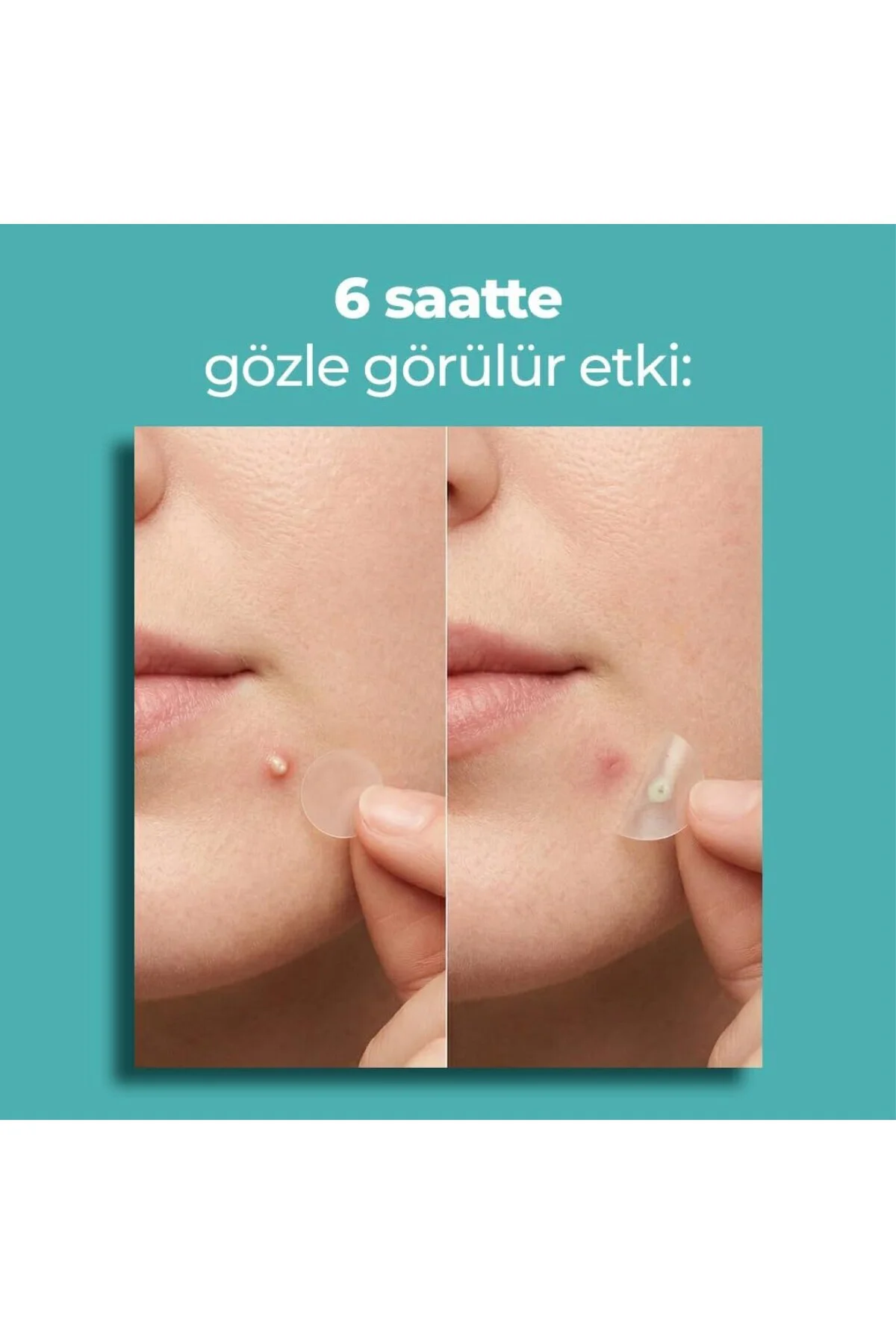 Bandı, Orijinal-Profesyonel Bakım, 144 Adet, Hidrokolloid Akne Ba