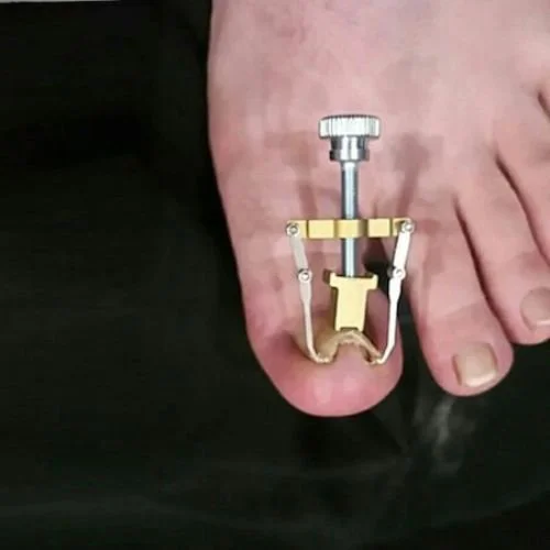 Batık Tırnak Düzeltme Aleti ile Sağlıklı ve Konforlu Ayak Bakımı