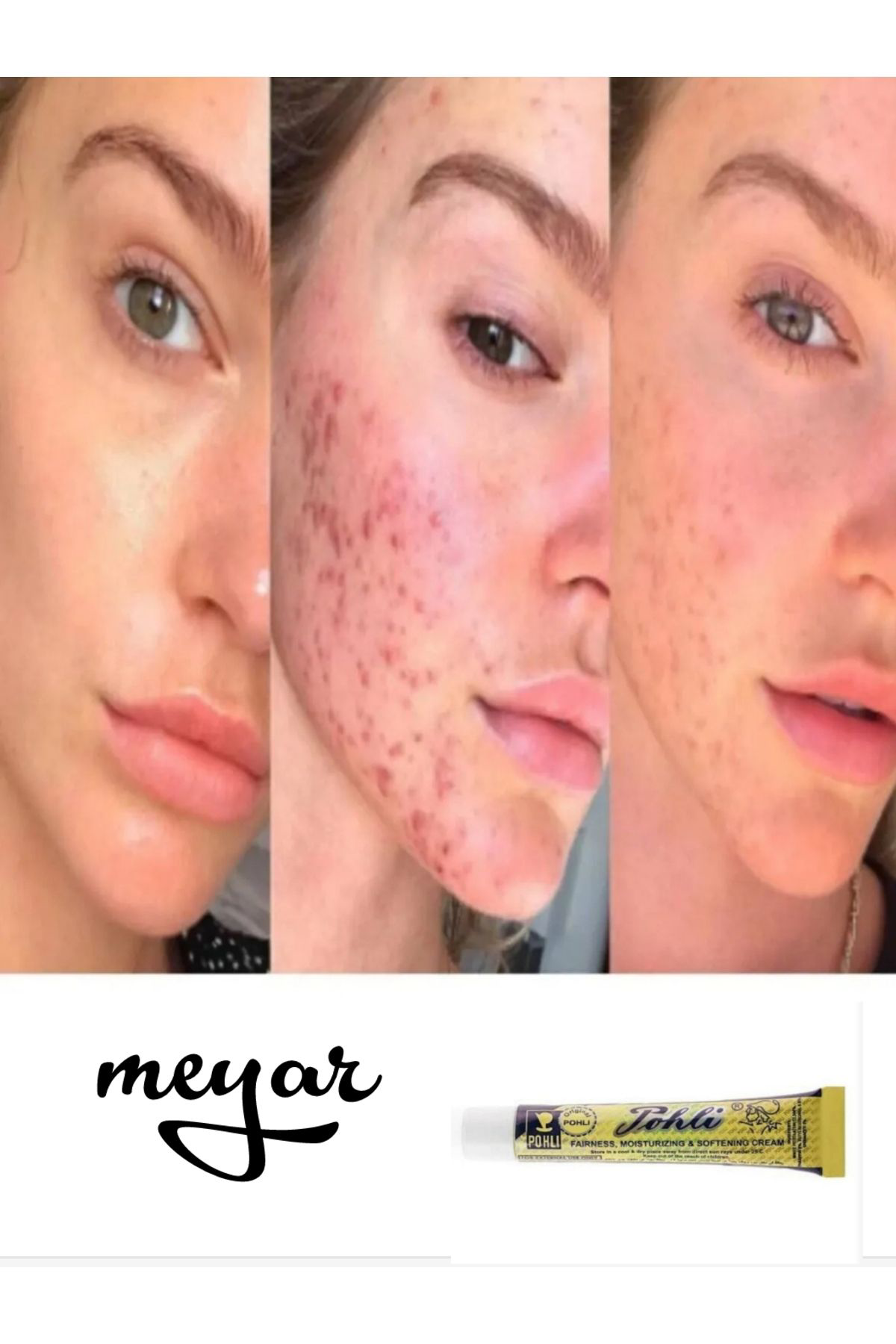 Pohli Beyazlatma, Sivilce Karşıtı, Melazma Ve Çil Giderici