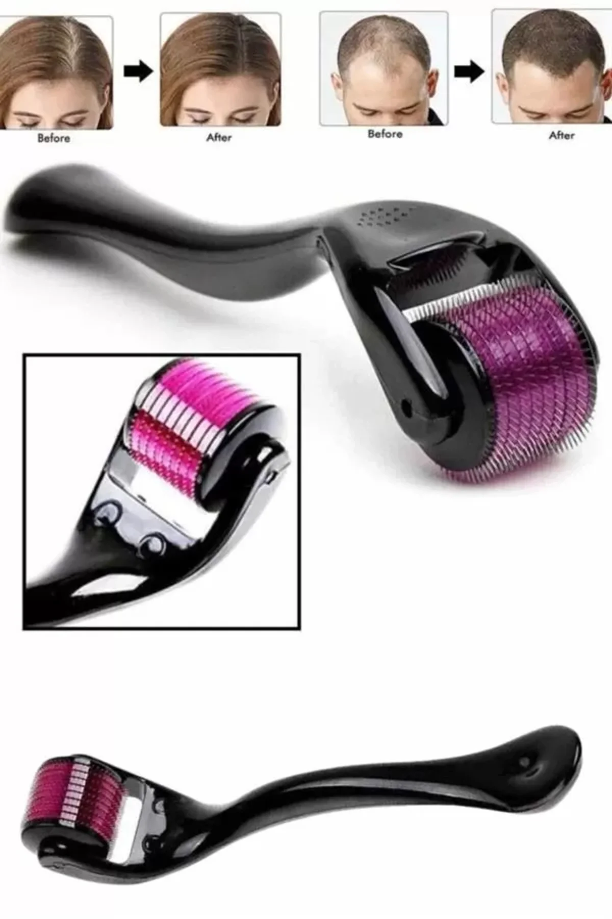 Derma Roller Titanyum Uçlu 540 İğneli 1 Mm Saç Ve Cilt Bakım Masa