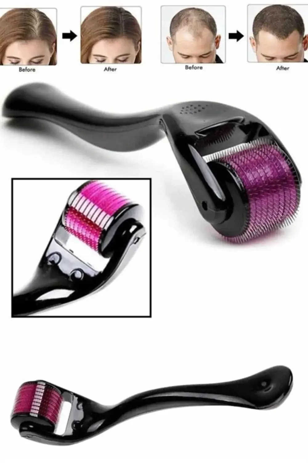 DRNDS Derma Roller Titanyum Uçlu 540 İğneli 1 Mm Saç Ve Cilt Bakı