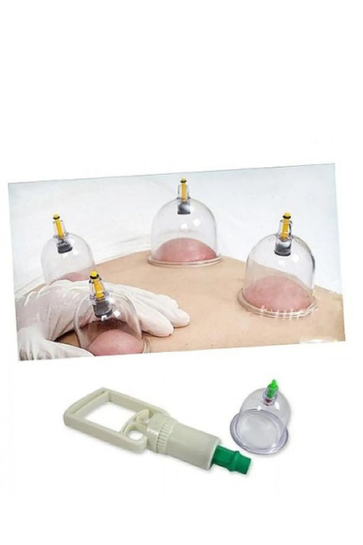 Hacamat Seti - Vakumlu Kupa Çekme Seti (MODEL 2)