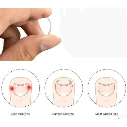 İthalat® Batık Tırnak Düzeltici Aparat