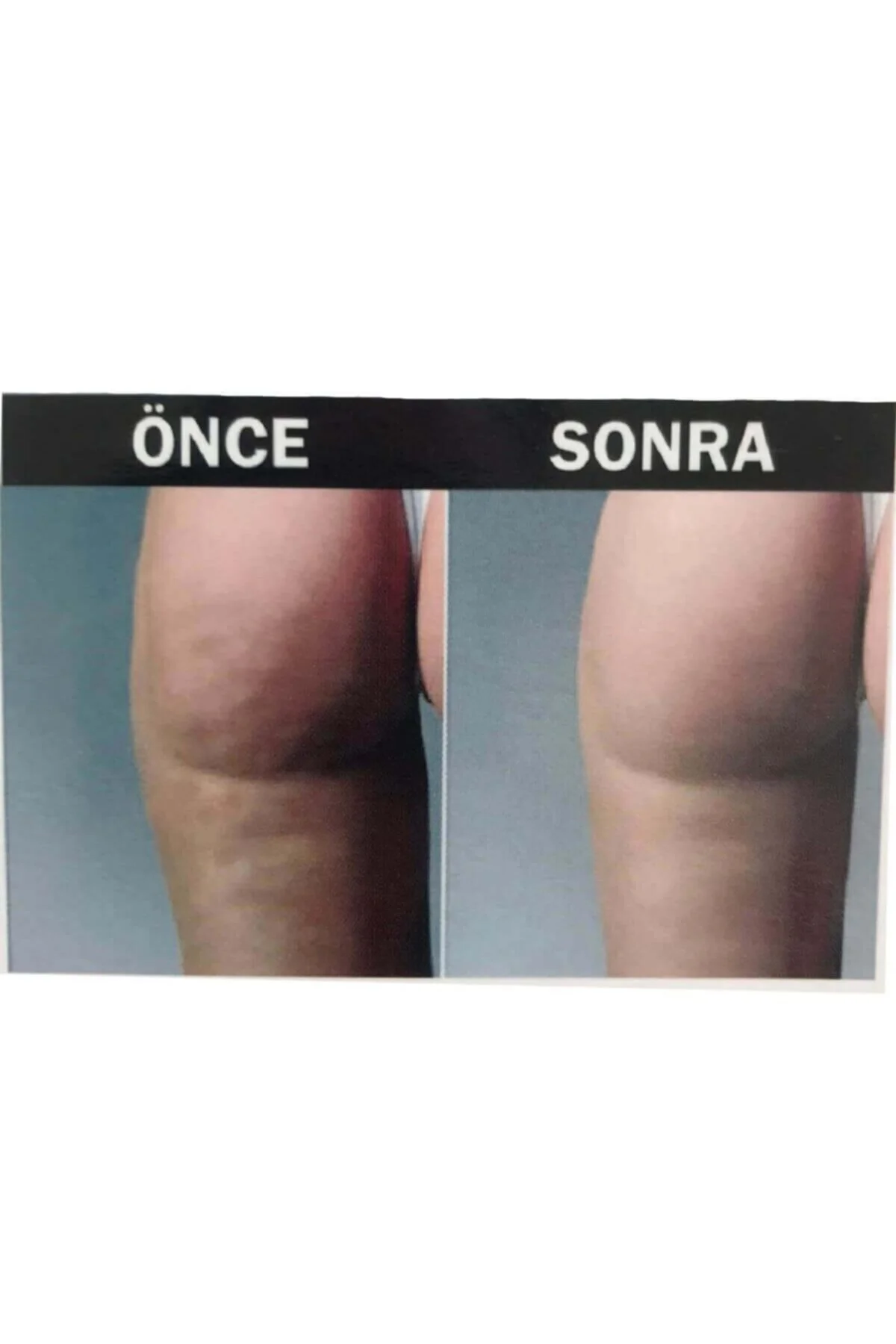 Kadın Anti-cellulite ( Selülit Giderici ) Masajlı Dikişsiz Paçalı Korse