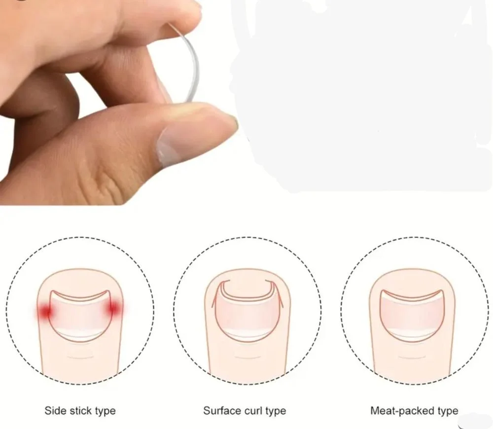 Mey İthalat® Ayak Tırnak Batmasını Önleyen Metal Aparat – Sağlıkl Mey İthalat® Ayak Tırnak Batmasını Önleyen Metal Aparat – Sağlıkl