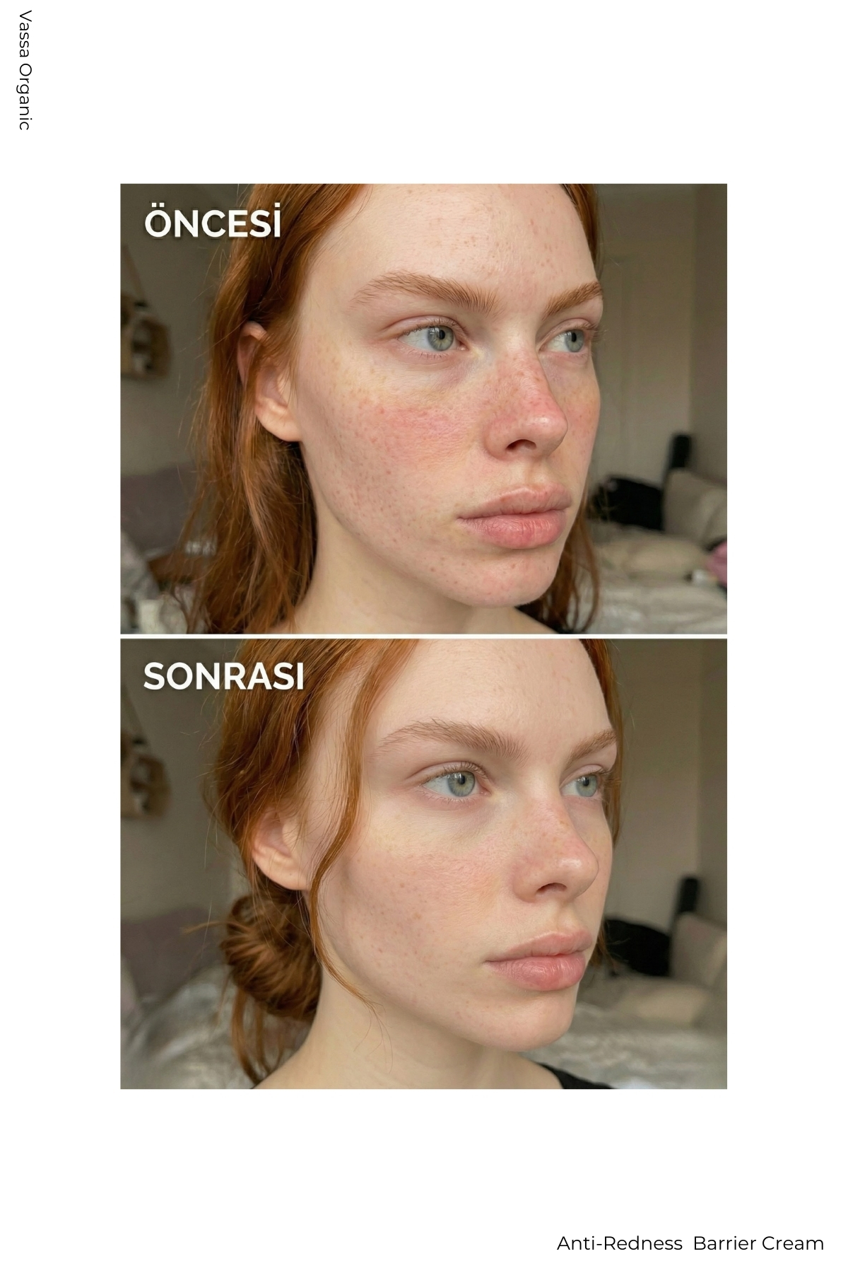 Pişik, Kızarıklık ve Tahriş Karşıtı Yatıştırıcı Onarıcı Bakım Kremi – Pişik Önleyici Krem 100 ml