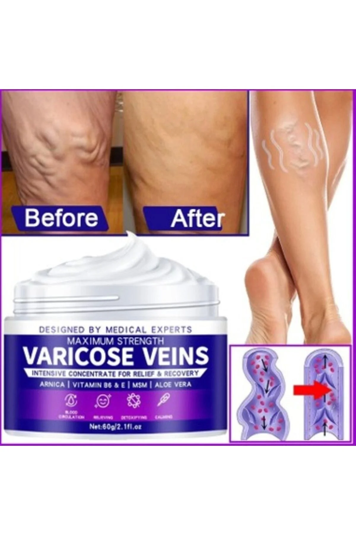 Strength Varicose Vein Tedavi Kremi – 100 Ml X 2 ADET | Seyrelmiş Damak Kremi