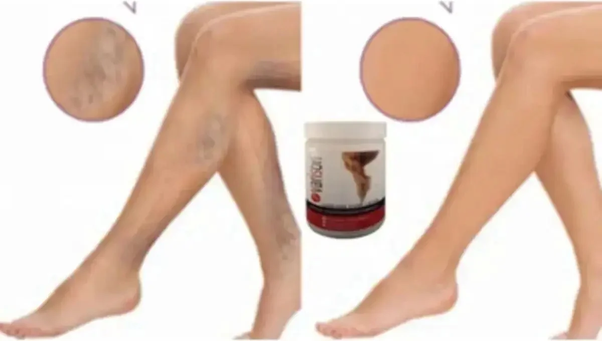 Süper Kremi 200ML / Varison Cream 200ML x 3 Adet – Etkili ve Kolay Tüy Alma Çözümü