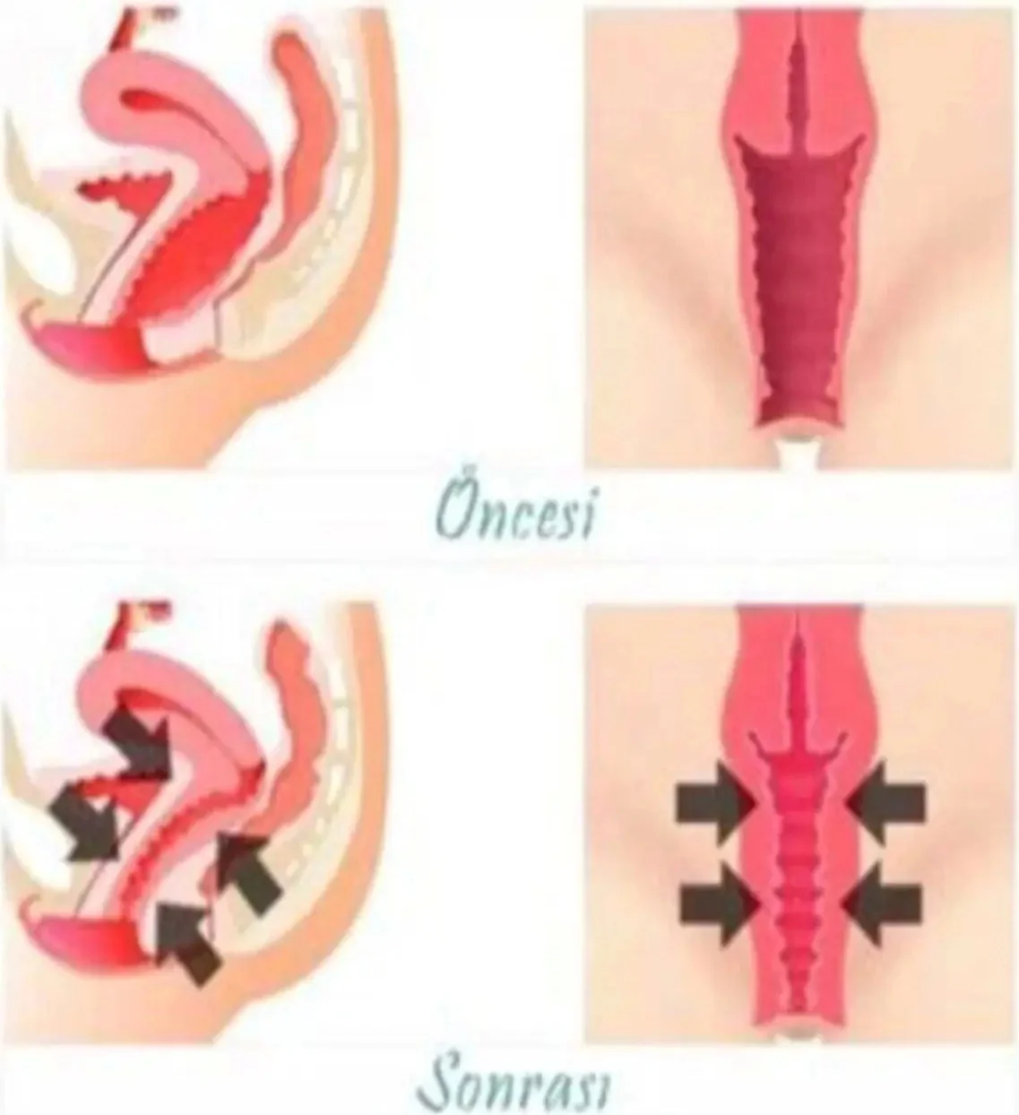 Süper Vagitight Kadınlar İçin Genital Bölge Krem 100 ml x 2 Adet - Sıkılaştırıcı Bakım Fiyatı, Yorumları ve Özellikleri