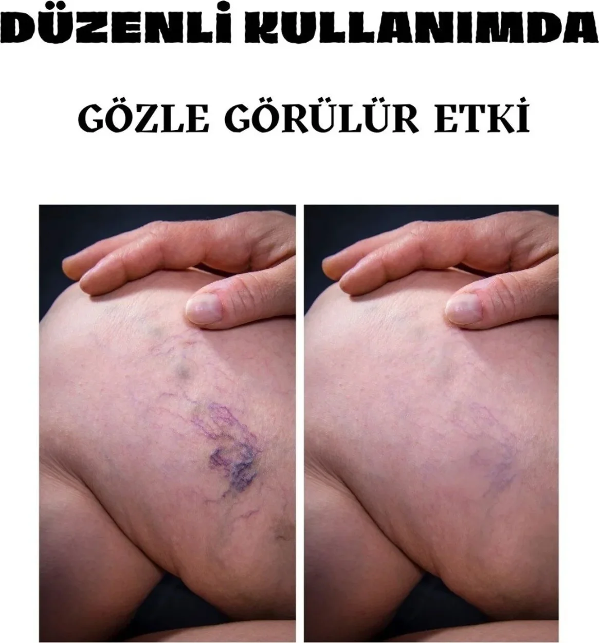 Süper Varicose Kremi 100 ml – Toplarak Damak Sorunlarına Karşı Etkili Çözüm