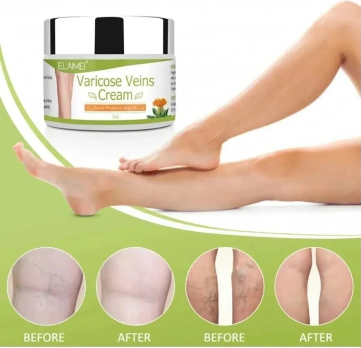Süper Varicose Kremi 100 ml – Toplarak Damak Sorunlarına Karşı Etkili Çözüm
