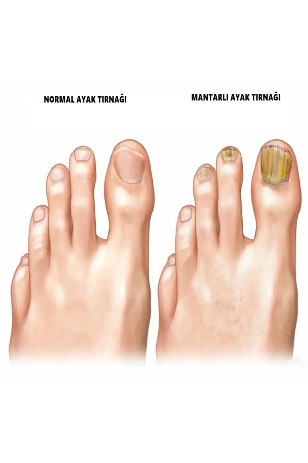 Tırnak Bakım ve Ayak Kremi -Tırnak Mantarı Önleyici Losyon Damla