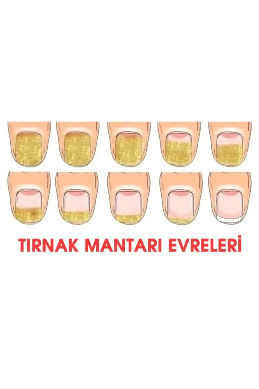 Tırnak Bakım ve Ayak Kremi -Tırnak Mantarı Önleyici Losyon Damla