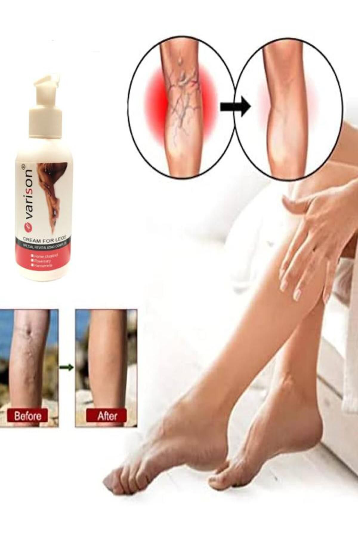 Helsol Varicose Vein Defense Var.İs Bacak Bakım Kremi 120 Ml X 1 Adet