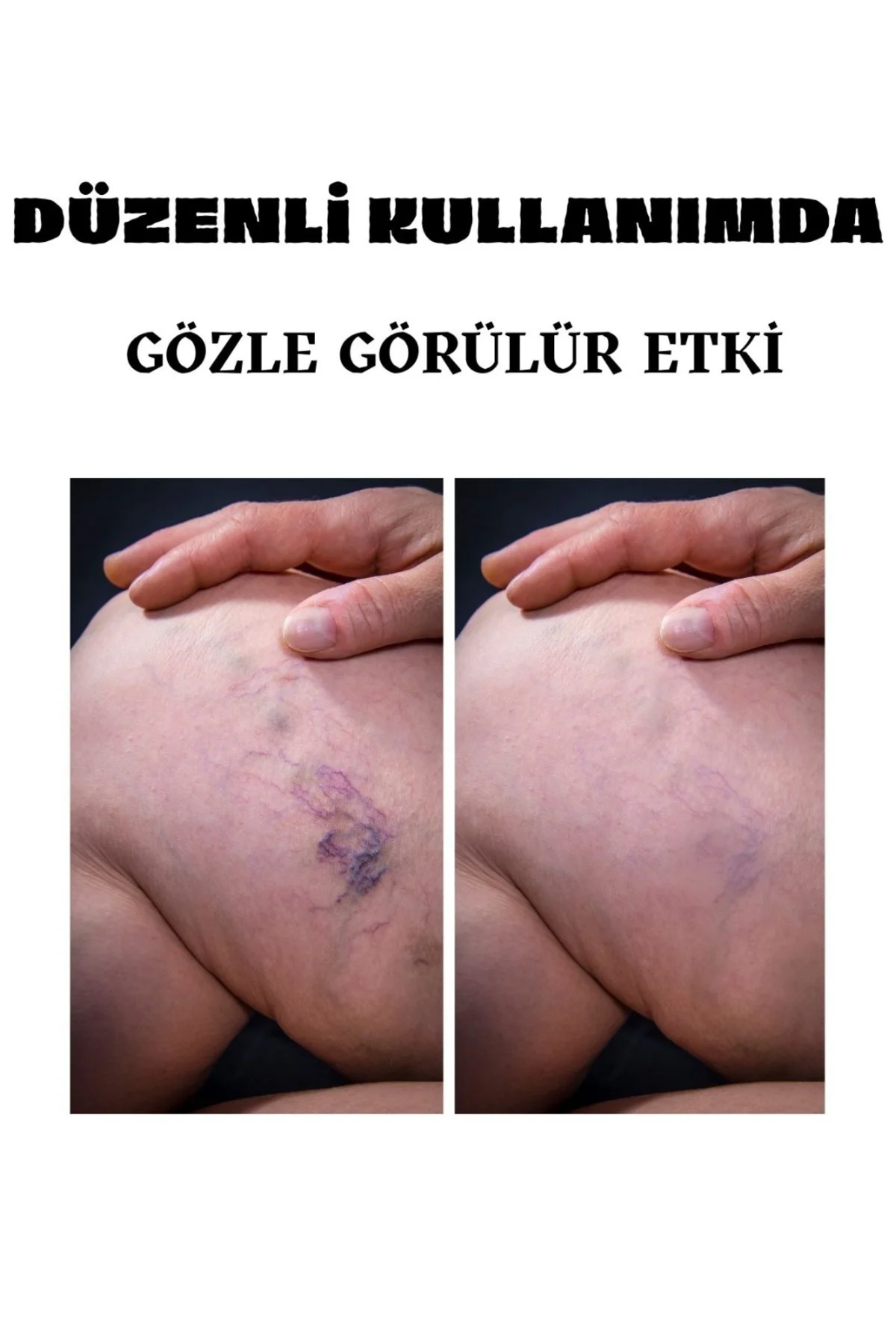 Varis Kremi 100 ML – Damar Varisleri ve Ağrıları İçin Etkili Bakım