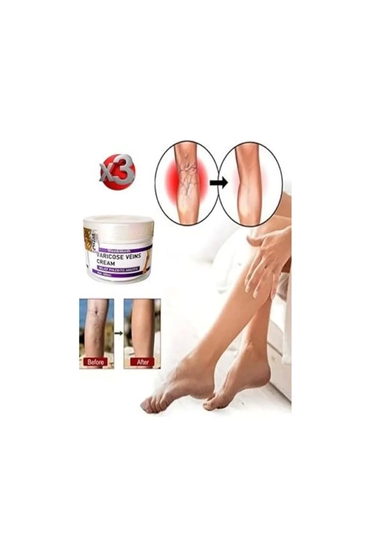 Varis ve Örümcek Damar Kremi - Bacak Ağrısına İyi Gelen Rahatlatıcı Bakım Kremi 100 ml x 3