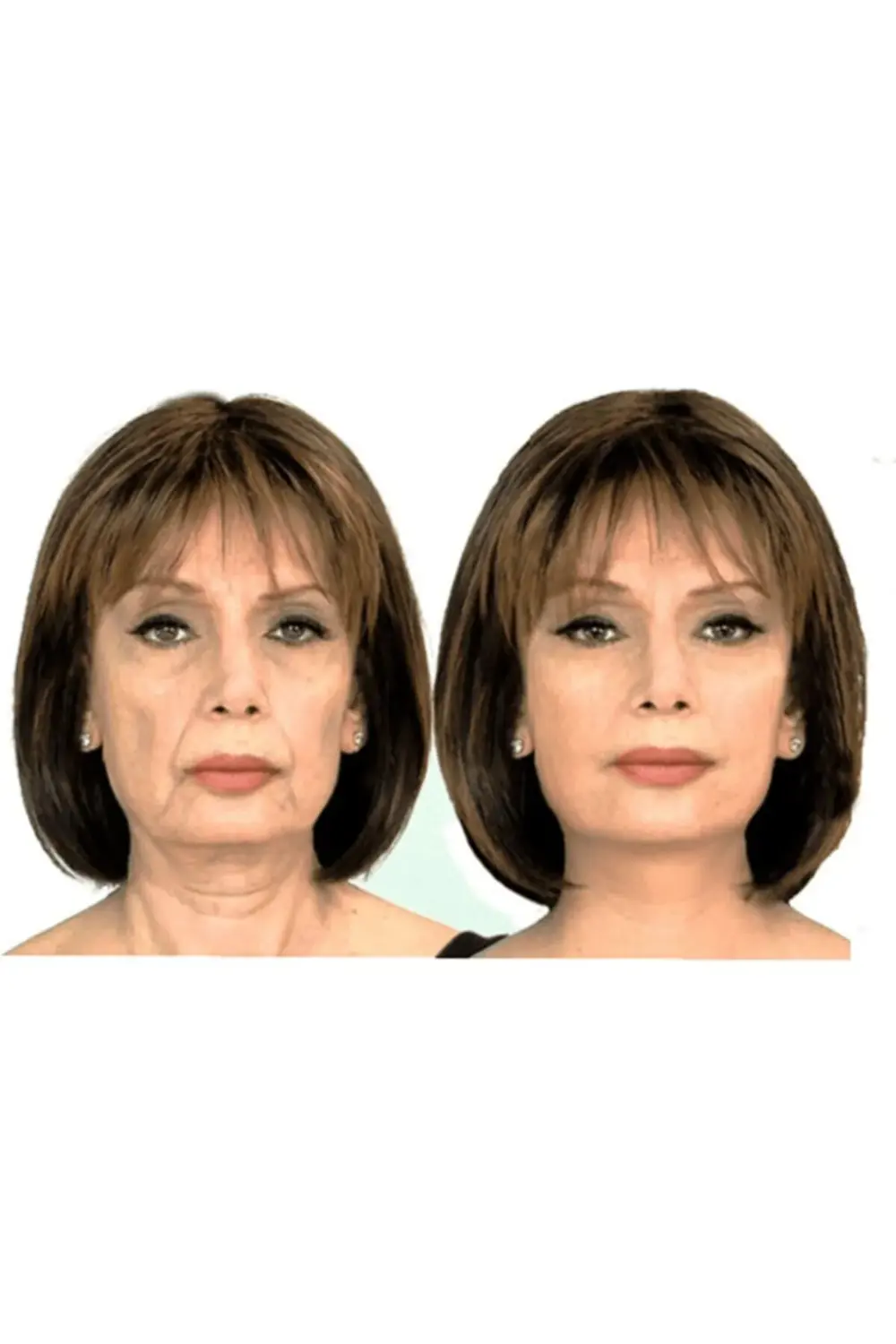 Yüz Gerdirme Bandı Kırışıklık Oluşumunu Engelleme Bandı Yüz Germe